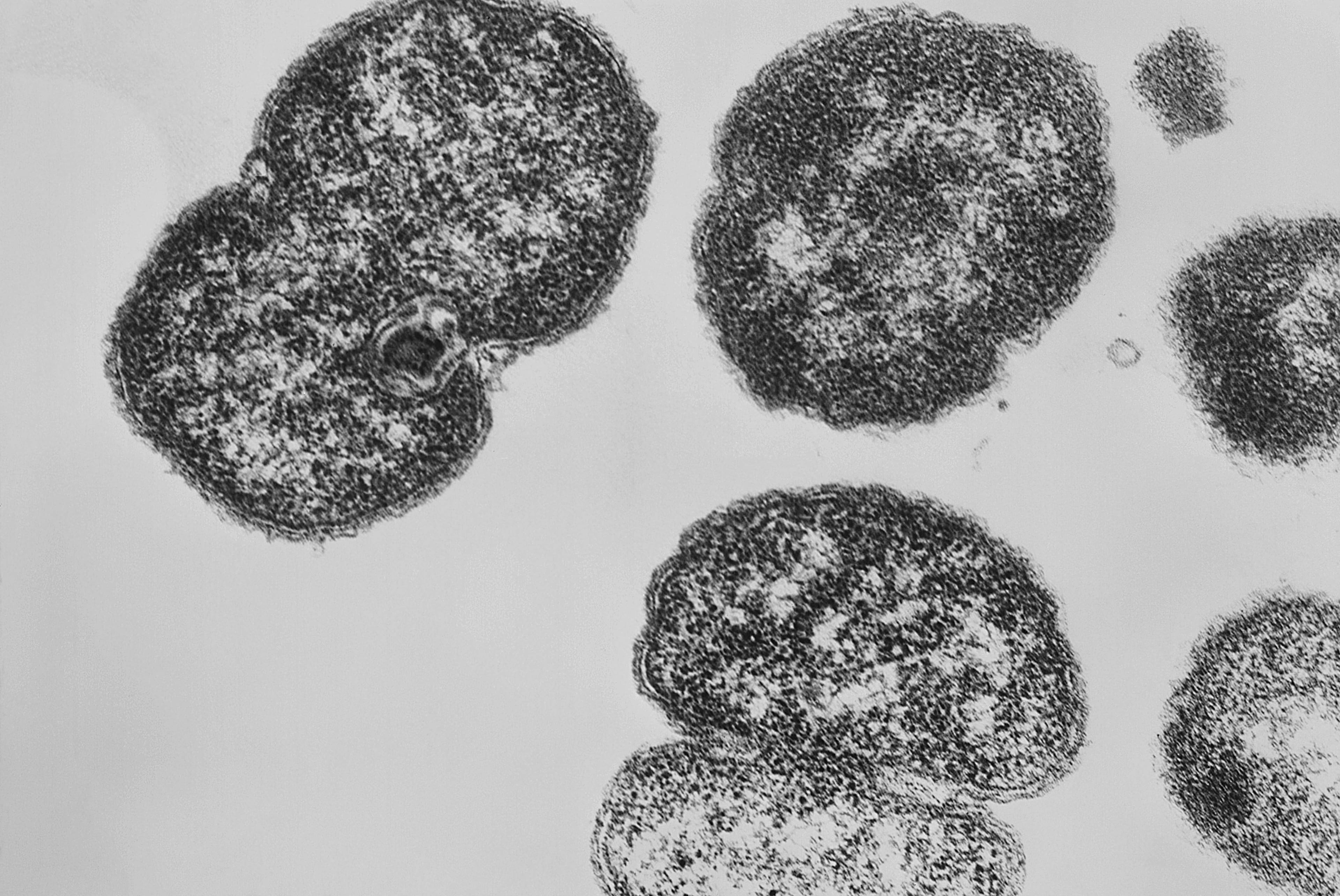 Gonorrhea stock photo